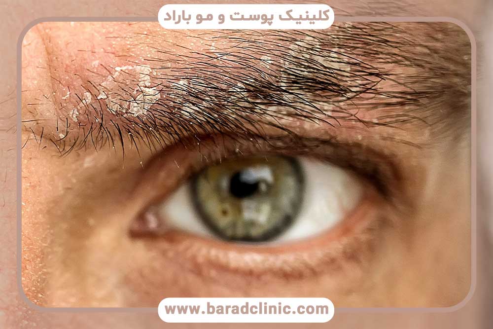 درمان پوسته پوسته شدن ابرو بعد از کاشت