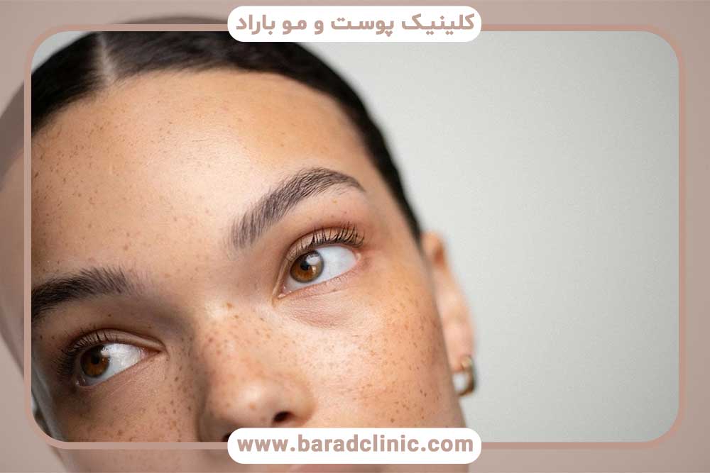 مراقبت‌های کاشت ابرو