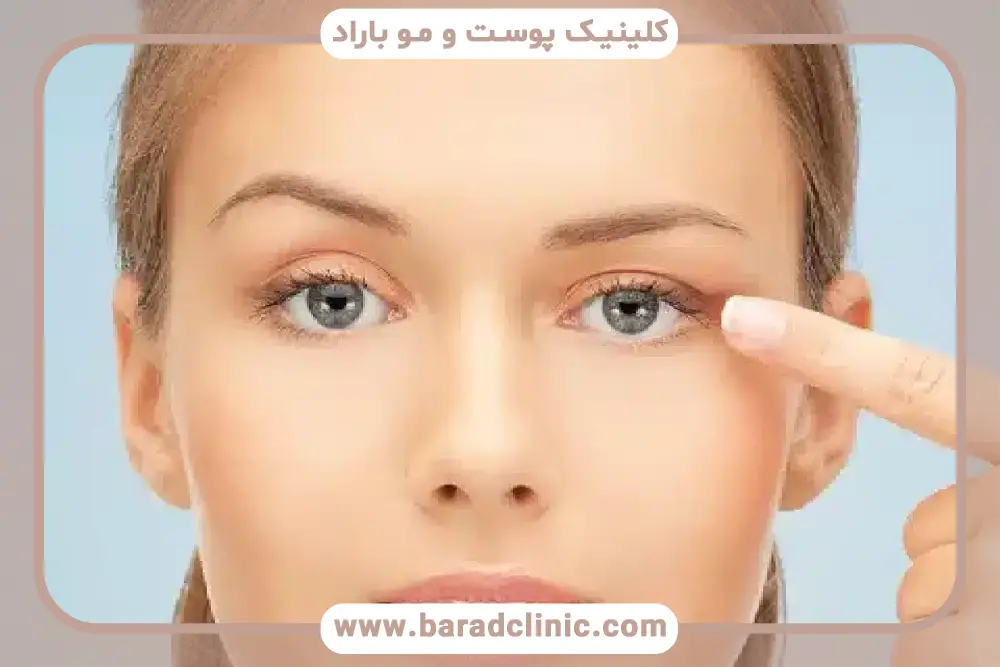بررسی روند بهبودی در تصاویر افتادگی پلک بعد از تزریق بوتاکس