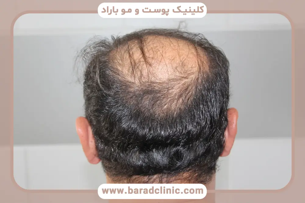 از کجا بفهمیم بانک موی خوبی داریم؟ علائم ضعیف بودن بانک مو