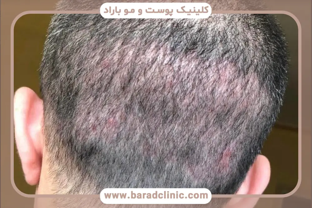 روش‌های پزشکی تقویت بانک مو قبل از کاشت 