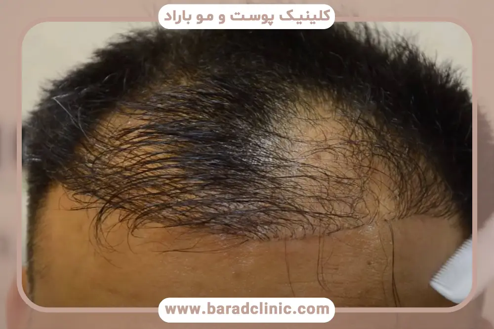 اصلاح کاشت مو عروسکی 