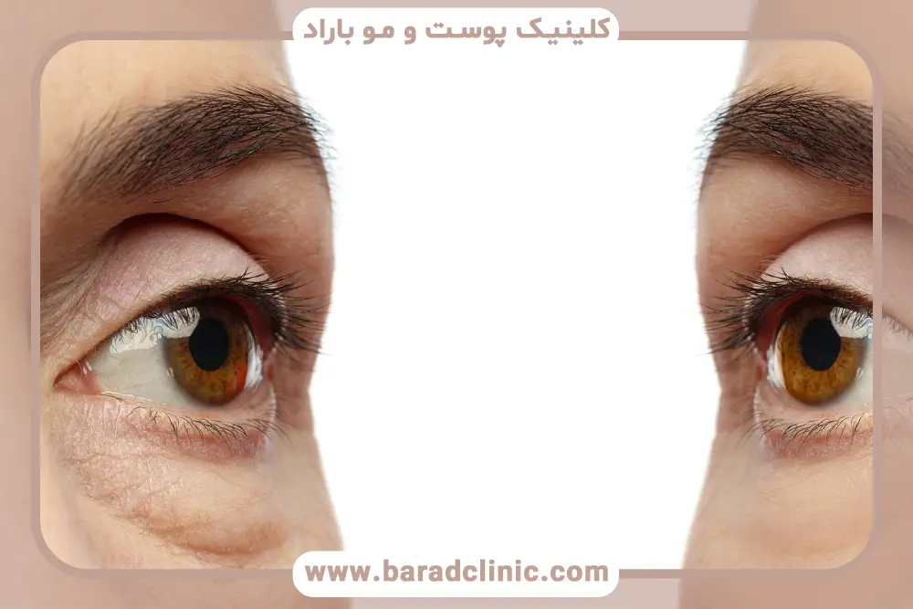تشخیص انحراف چشم بعد از بلفاروپلاستی 