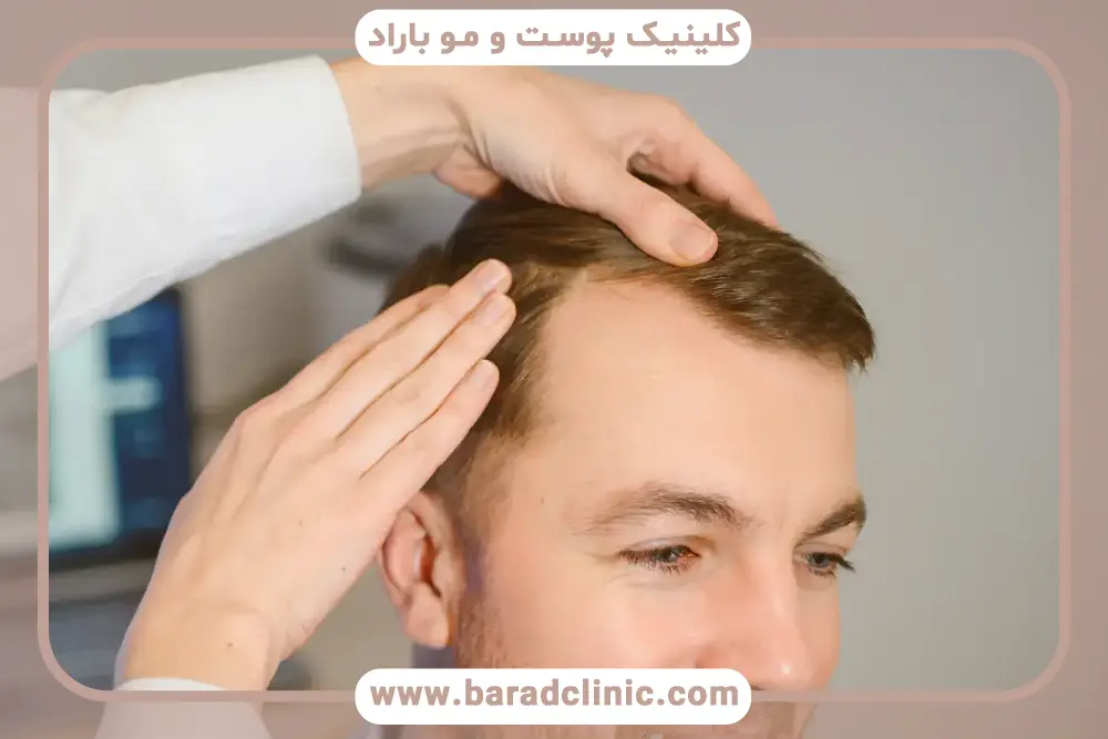 عوارض احتمالی روش کاشت موی MIA 