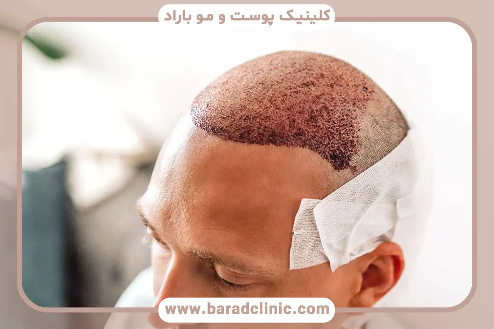 مراقبت های بعد از کاشت مو در روز اول