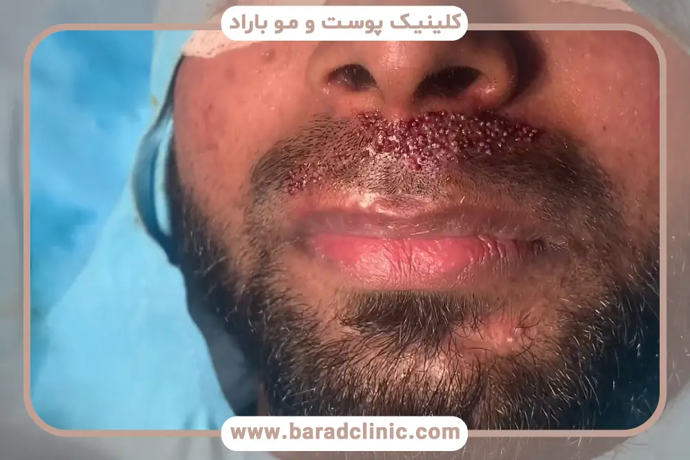 روش‌های رفع جای زخم کاشت ریش 
