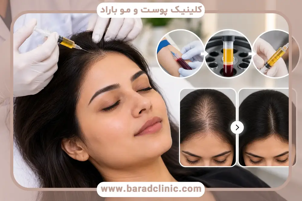 مراحل پی آر پی موها