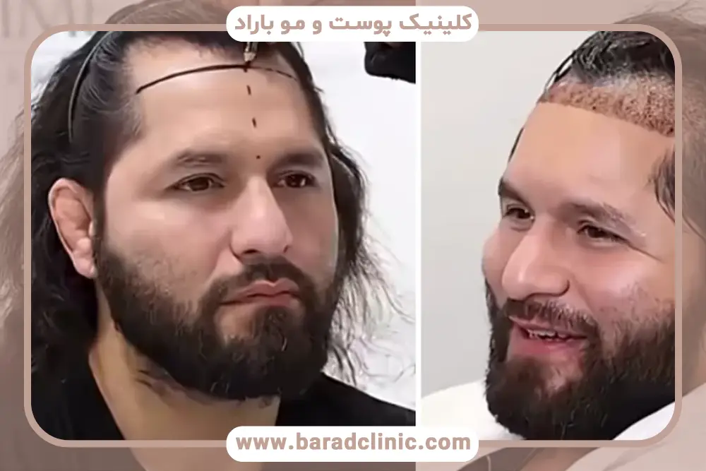 تاثیر مراقبت‌های بعد از کاشت روی ماندگاری کاشت مو 
