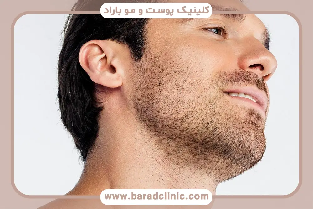 شرایط پزشکی کاندیدای کاشت ریش 