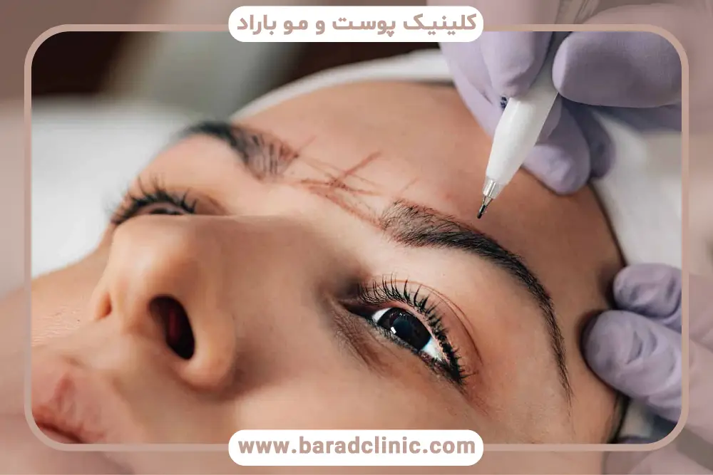 بهترین روش درمان افتادگی پلک