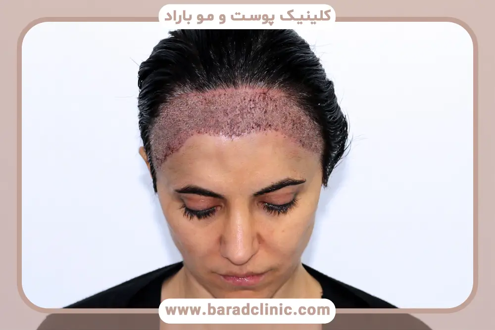 کنترل ریزش از شرایط کاشت مو در زنان