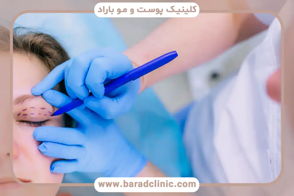 عوارض جراحی بلفاروپلاستی پلک بالا و پایین