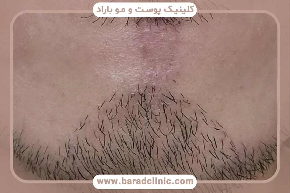 درمان جوش بعد از کاشت ریش