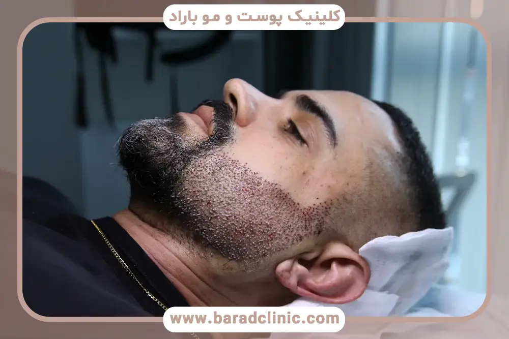 انتخاب زاویه کاشت در طراحی خط ریش قبل از کاشت