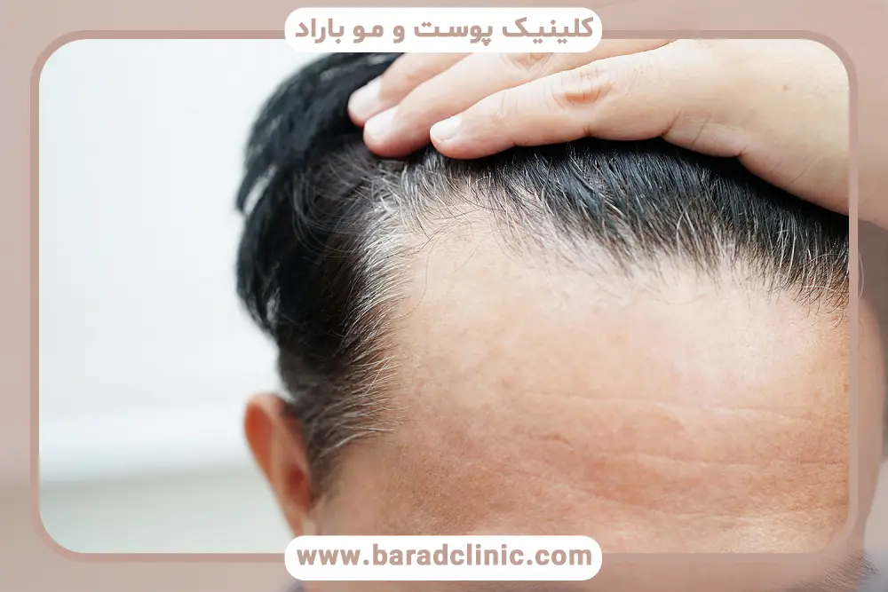 مزایا و محدودیتهای کاشت مو به روش AMT