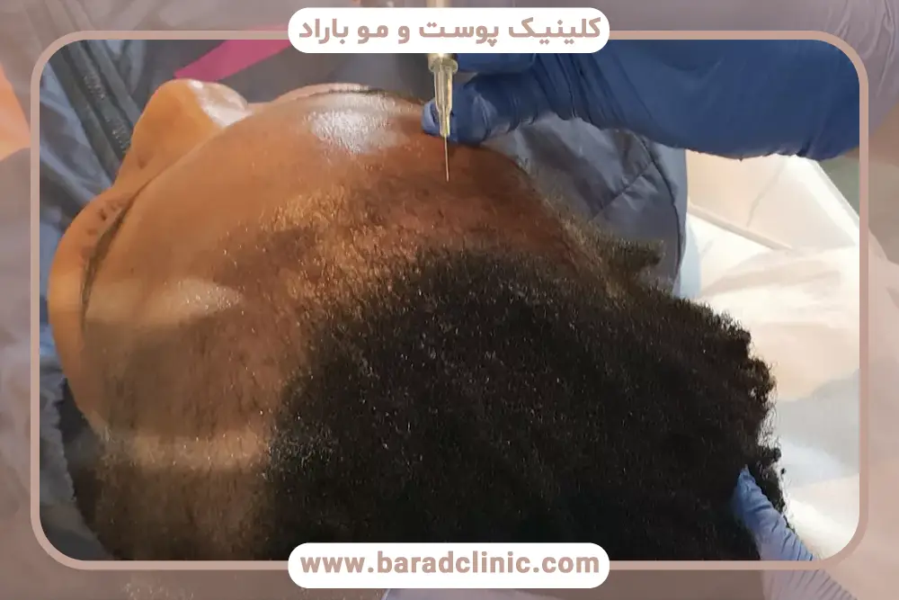 کاندیدای نامناسب کربوکسی تراپی بعد از کاشت مو 