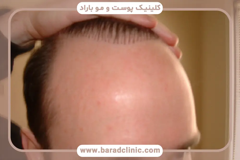 روش‌های ترمیم کاشت موی ناموفق