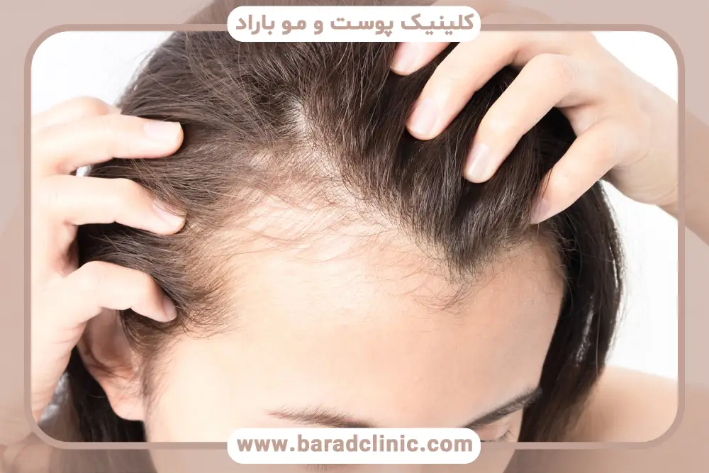 دلایل کمبود فریتین و ریزش مو